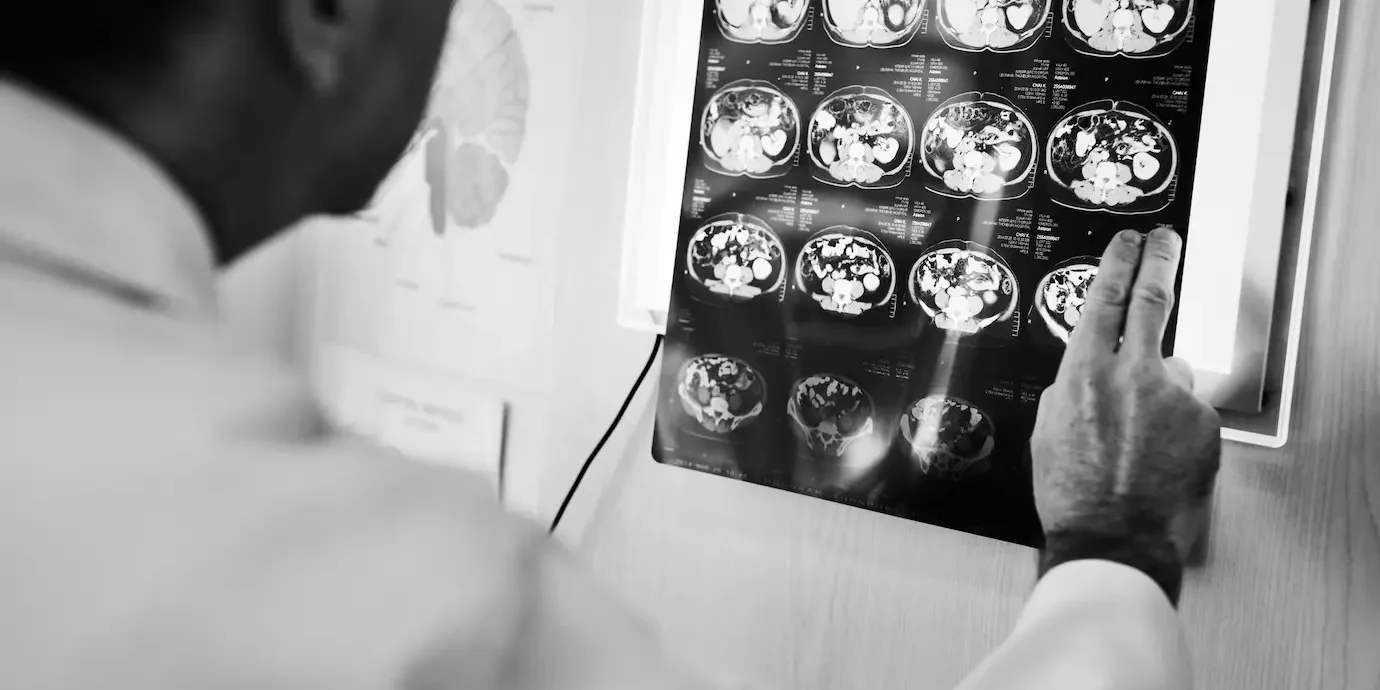 Intracranial Tuberculomas