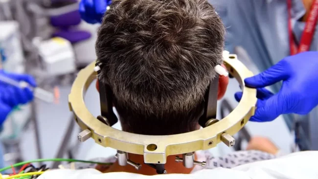 Stereotactic Brain Tumor Surgery Stereotactic Brain Tumor Surgery